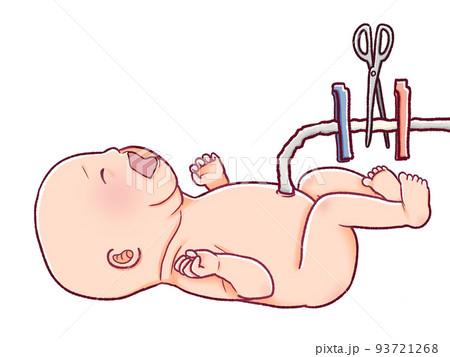 生まれたての赤ちゃんのへその緒を切るイラスト 93721268