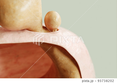 Mixed form of hiatus hernia type 3 - entrance to the stomach and protrusion of the stomach through the diaphragm - 3D rendering 93738202