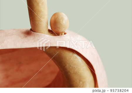 Paraesophageal Hiatus Hernia Type 2 - Stomach protrusion through diaphragm, gastric entrance in normal condition - 3D rendering Paraesophageal Hiatus Hernia Type 2 - Stomach protrusion through diaphragm, gastric entrance in normal condition - 3D rendering 93738204