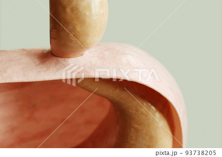 Axial hiatus hernia type 1 - entrance to the stomach via the diaphragm - 3D rendering 93738205