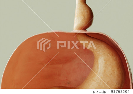Axial hiatus hernia type 1 - entrance to the stomach via the diaphragm - 3D rendering 93762504