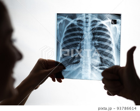 Doctor looks at x-ray of patient's lungs and shows thumb up.  93786614
