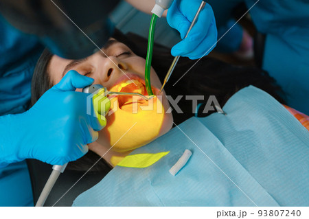 Dentist uses photopolymer lamp to cure carious teeth of the patient Dentist uses photopolymer lamp to cure carious teeth of the patient 93807240