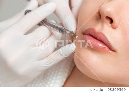 A woman makes lip shape correction in a cosmetology clinic. Lips injections, lip augmentation. A woman makes lip shape correction in a cosmetology clinic. Lips injections, lip augmentation. 93809569