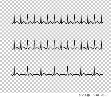 atrial tachycardia 93810628