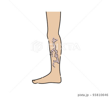 下肢静脈瘤 93810646