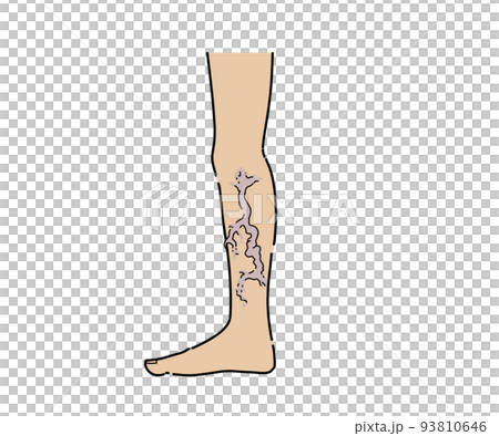 下肢静脈瘤 93810646