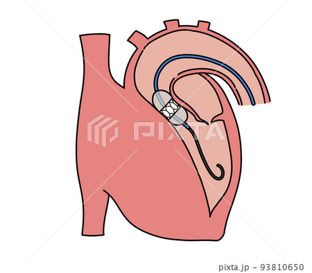 経カテーテル的大動脈弁留置術 93810650