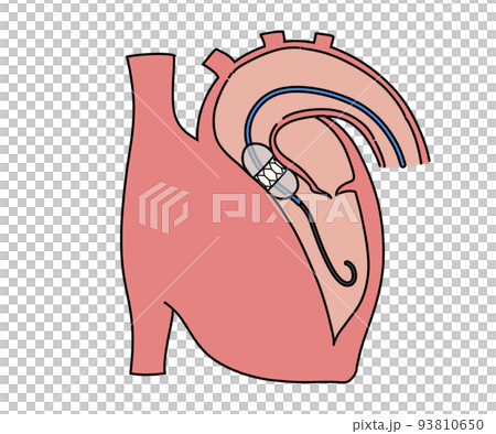 Transcatheter aortic valve placement 93810650