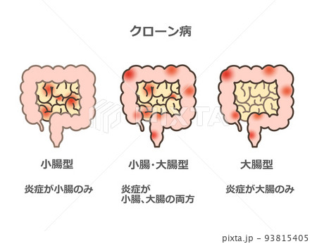 クローン病の入院費はどれくらいかかりますか?
