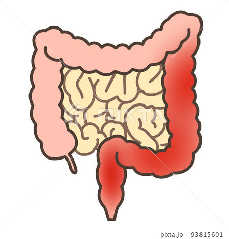 潰瘍性大腸炎左側 93815601