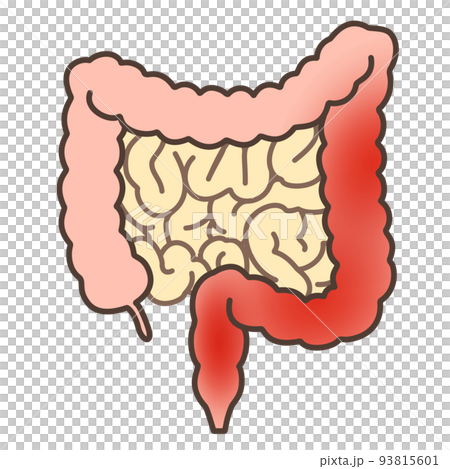 潰瘍性大腸炎左側 93815601