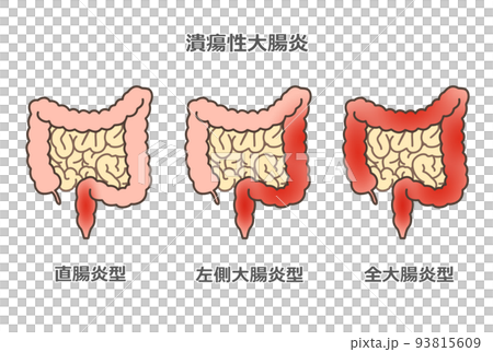 Ulcerative colitis - Stock Illustration [93815609] - PIXTA