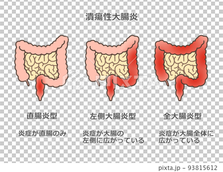Ulcerative colitis - Stock Illustration [93815612] - PIXTA