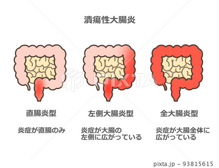 潰瘍性大腸炎 93815615