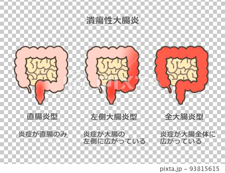 潰瘍性大腸炎 93815615