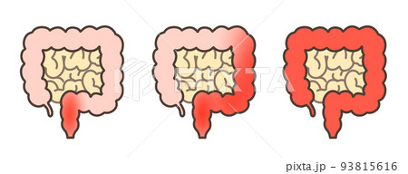 潰瘍性大腸炎の再燃症状