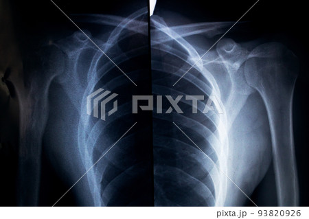 X-ray of the shoulder from both sides X-ray of the shoulder from both sides 93820926