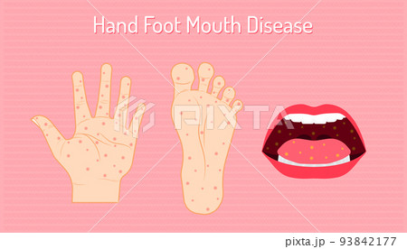 hand foot mouth disease. enteroviruses or EV71 is name of virus. be careful of your chidren and yourself. beautiful color background. vector illustration eps10 93842177