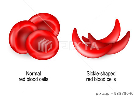 normal erythrocytes and sickle-shaped red blood cells. normal erythrocytes and sickle-shaped red blood cells. 93878046