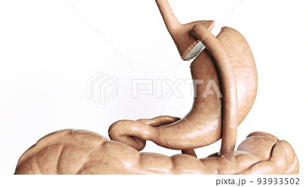 Stomach reduction 2 of 4- Roux en Y Gastric Bypass - 3D Rendering 93933502