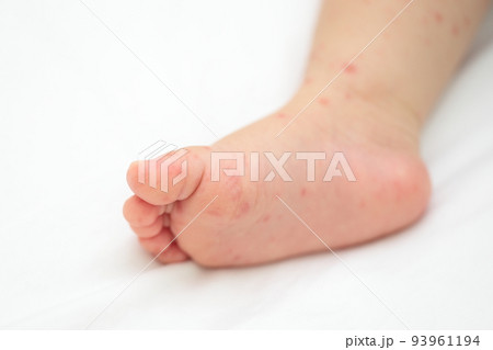 手足口病にかかった赤ちゃんの足 93961194