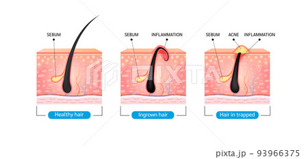Ingrown hair. Hair has grown back into the skin surface after shaving. Formation of skin acne or pimple. Ingrown hair. Hair has grown back into the skin surface after shaving. Formation of skin acne or pimple. 93966375