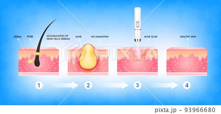 Formation of skin acne or pimple. Accumulation of dead cells the sebum in the clogged pore promotes growth of bacteria. Acne scar vascular laser treatment. Medical beauty skin care concept. 3D vector. 93966680
