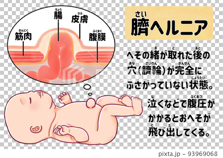 Baby's umbilical hernia - Easy-to-understand Japanese illustration 93969068