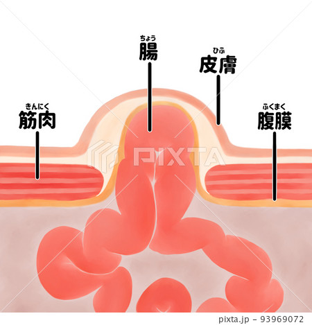 人体解剖図 臍ヘルニアの水彩イラスト 人体解剖図 臍ヘルニアの水彩イラスト 93969072