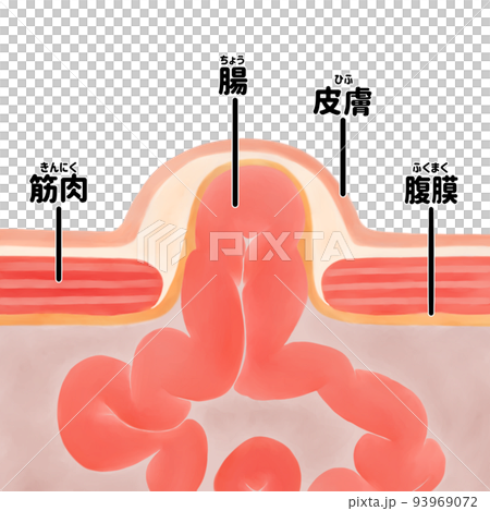 人体解剖図 臍ヘルニアの水彩イラスト 人体解剖図 臍ヘルニアの水彩イラスト 93969072