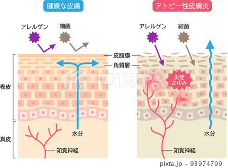 アトピー性皮膚炎と健康な皮膚　肌細胞と断面図 93974799