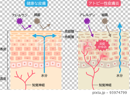 アトピー性皮膚炎と健康な皮膚　肌細胞と断面図 93974799