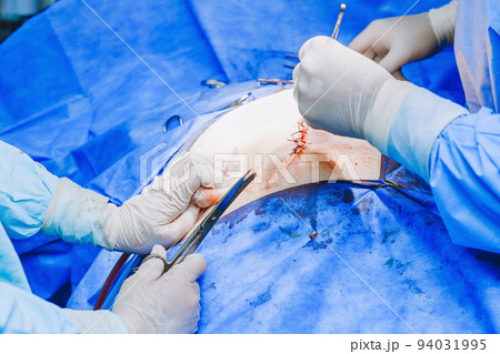 Hands of surgeons in sterile gloves close-up. Hands of surgeons in sterile gloves close-up. 94031995