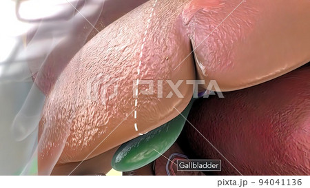 liver and gallbladder surgery Anatomy 3D illustration 94041136