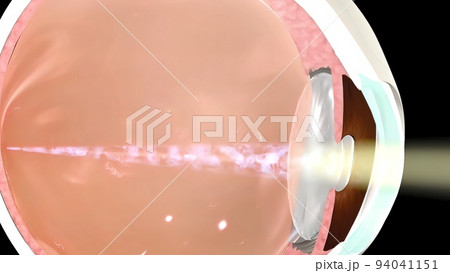Anatomy of the Eye. Loss of vision in the eye 94041151
