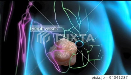 Interaction of tumor cells and lymphatic vessels in cancer Interaction of tumor cells and lymphatic vessels in cancer 94041287