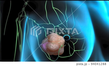 Interaction of tumor cells and lymphatic vessels in cancer Interaction of tumor cells and lymphatic vessels in cancer 94041288
