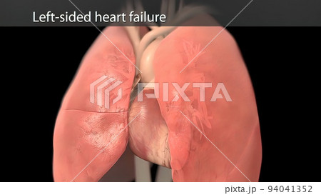 The Central Role of Left Atrium in Heart Failure 94041352