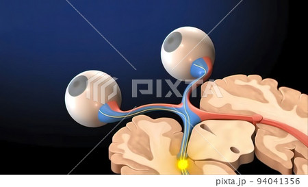 Medical 3D illustration of The Lateral Geniculate Nucleus 94041356