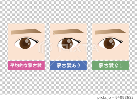 Cosmetic surgery Mongolian fold condition 94098652