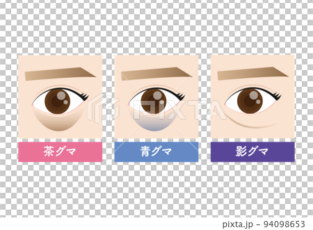 黑眼圈的美容類型 94098653