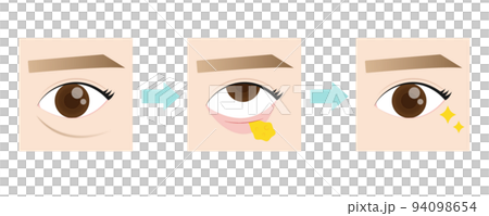 整容手術去除眼下脂肪 94098654