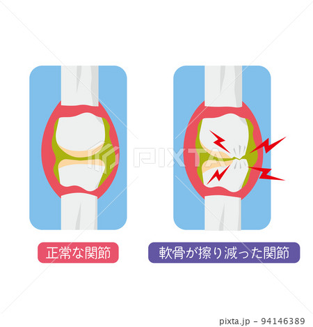 軟骨がすり減った関節のイラスト 軟骨がすり減った関節のイラスト 94146389