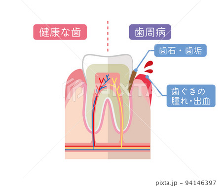 健康な歯と歯周病の歯の説明 健康な歯と歯周病の歯の説明 94146397