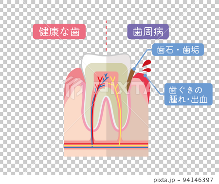 健康な歯と歯周病の歯の説明 94146397