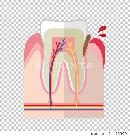 健康な歯と歯周病の歯 94146399