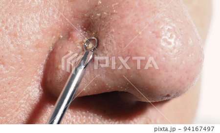 Acne and problem pores. Squeezing blackhead pimple with stainless steel medical acne remover tool. Pressing white and blackhead pimples from nose pores. Acne skin problem closeup. skin care treatment. Acne and problem pores. Squeezing blackhead pimple with stainless steel medical acne remover tool. Pressing white and blackhead pimples from nose pores. Acne skin problem closeup. skin care treatment. 94167497