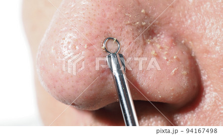 Acne and problem pores. Squeezing blackhead pimple with stainless steel medical acne remover tool. Pressing white and blackhead pimples from nose pores. Acne skin problem closeup. skin care treatment. 94167498