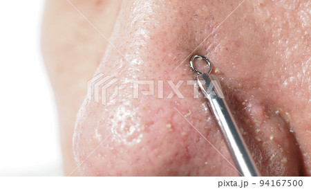 Acne and problem pores. Squeezing blackhead pimple with stainless steel medical acne remover tool. Pressing white and blackhead pimples from nose pores. Acne skin problem closeup. skin care treatment. Acne and problem pores. Squeezing blackhead pimple with stainless steel medical acne remover tool. Pressing white and blackhead pimples from nose pores. Acne skin problem closeup. skin care treatment. 94167500